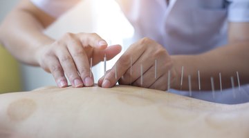 How to Become an Acupuncturist in Canada