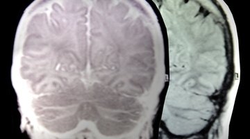 The human brain has two hemispheres--left and right.